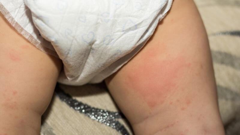 16 bệnh da liễu thường gặp trong mùa nắng nóng bạn nên biết