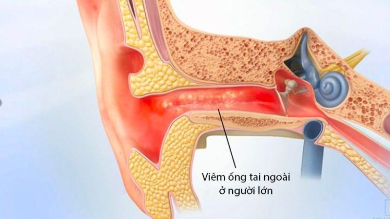 Viêm tai ngoài là tình trạng nhiễm trùng ở ống tai ngoài