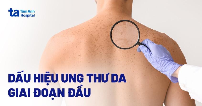 Ung thư da giai đoạn đầu: Dấu hiệu, chẩn đoán và cách điều trị