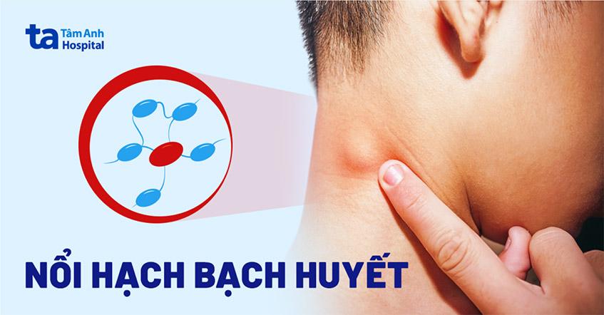 nổi hạch bạch huyết