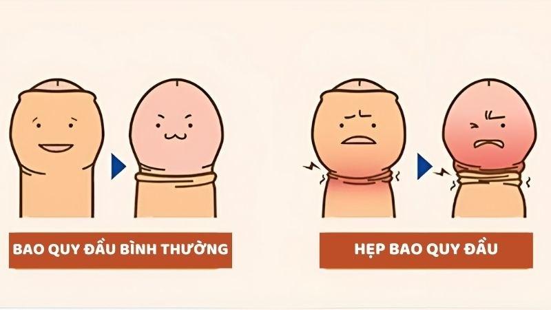 Hẹp bao quy đầu đặc biệt phổ biến ở độ tuổi thanh thiếu niên