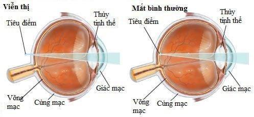 Viễn thị và lão thị khác nhau thế nào?