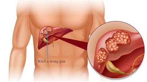 Ung thư gan ảnh hưởng nghiêm trọng đến sức khỏe người bệnh