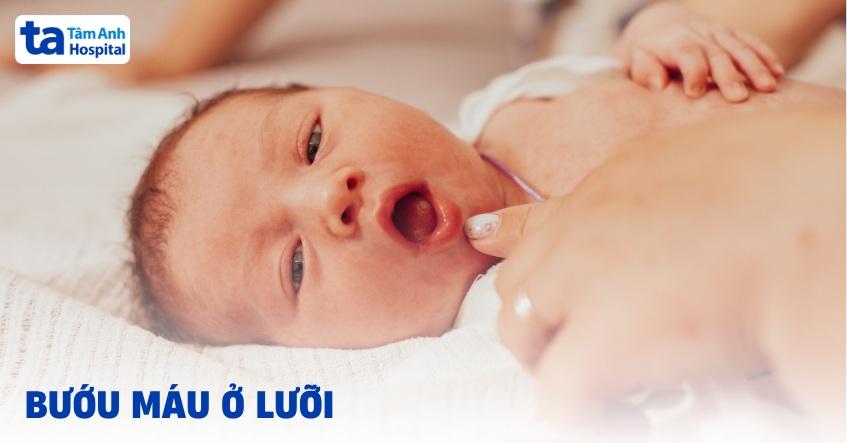 Bướu máu ở lưỡi: Nguyên nhân, triệu chứng và cách chẩn đoán bệnh