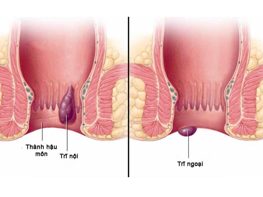 Các phương pháp điều trị bệnh trĩ