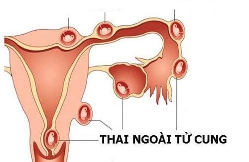 Thai ngoài tử cung là bệnh lý mà việc làm tổ của thai xảy ra ở một vị trí khác ngoài lớp nội mạc tử cung buồng tử cung